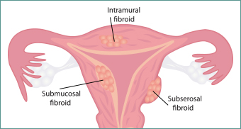 UTERINE FIBROIDS